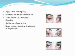  Right third nerve palsy
 showing limitation of elevation
 Same patient as in Figure 2
showing
 limitation of adduction
 Same patient showing limitation
of depression
 