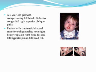  A 2-year-old girl with
compensatory left head tilt due to
congenital right superior oblique
palsy.
 Patient with traumatic bilateral
superior oblique palsy; note right
hypertropia on right head tilt and
left hypertropia on left head tilt.
 