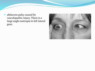  abducens palsy caused by
vasculopathic injury. There is a
large angle esotropia in left lateral
gaze.
 