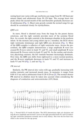resting heart rate varies with age; newborns can range from 90–160 beats per
minute (bpm) and adolescents from 50–120 bpm. The average heart rate
peaks about the second month of life and thereafter gradually decreases un-
til adolescence (Fig. 1). Heart rates grossly outside the normal range for age
should be scrutinized closely for dysrhythmias.
QRS axis
In utero, blood is shunted away from the lungs by the patent ductus
arteriosus, and the right ventricle provides most of the systemic blood
ﬂow. As a result, the right ventricle is the dominant chamber in the newborn
infant. In the neonate and young infant (up to 2 months), the ECG shows
right ventricular dominance and right QRS axis deviation (Fig. 1). Most
of the QRS complex is reﬂective of right ventricular mass. Across the pre-
cordium, the QRS complex demonstrates a large amplitude R wave (in-
creased R-/S-wave ratio) in leads V1 and V2, and small amplitude R wave
(decreased R-/S-wave ratio) in leads V5 and V6. As the cardiac and circula-
tory physiology matures, the left ventricle becomes increasingly dominant.
Over time, the QRS axis shifts from rightward to a more normal position,
and the R-wave amplitude decreases in leads V1 and V2 and increases in
leads V5 and V6 (Fig. 2; and see Fig. 1).
PR interval
Similarly, the PR interval also varies with age, gradually increasing with
cardiac maturity and increased muscle mass. In neonates, it ranges from
0.08–0.15 sec and in adolescents from 0.120–0.20 sec [3]. The normal shorter
PR interval in children must be taken into account when considering the
diagnosis of conduction and atrioventricular (AV) block.
Fig. 1. Normal ECG of 4-week-old infant. The ECG demonstrates right axis deviation and
large R-wave amplitude and inverted T waves in the right precordial leads (V1 and V2) indicat-
ing right ventricular dominance normally seen in early infancy. Also note the fast heart rate,
which is also normal for this age group.
197THE PEDIATRIC ECG
 