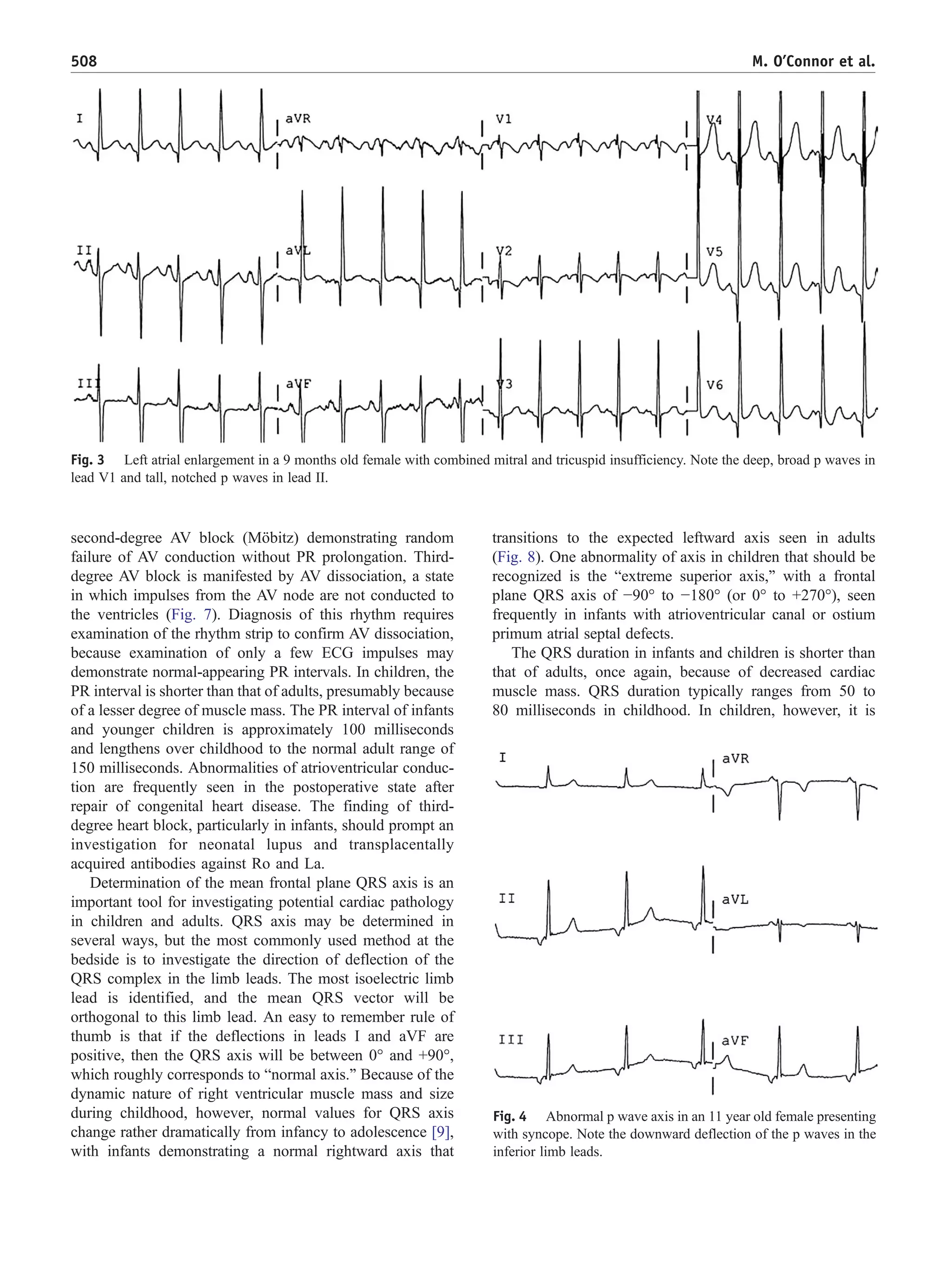 The pediatric electrocardiogram 1 | PDF