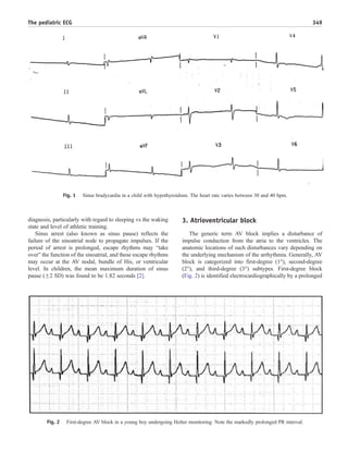 diagnosis, particularly with regard to sleeping vs the waking
state and level of athletic training.
Sinus arrest (also known as sinus pause) reflects the
failure of the sinoatrial node to propagate impulses. If the
period of arrest is prolonged, escape rhythms may “take
over” the function of the sinoatrial, and these escape rhythms
may occur at the AV nodal, bundle of His, or ventricular
level. In children, the mean maximum duration of sinus
pause (F2 SD) was found to be 1.82 seconds [2].
3. Atrioventricular block
The generic term AV block implies a disturbance of
impulse conduction from the atria to the ventricles. The
anatomic locations of such disturbances vary depending on
the underlying mechanism of the arrhythmia. Generally, AV
block is categorized into first-degree (1°), second-degree
(2°), and third-degree (3°) subtypes. First-degree block
(Fig. 2) is identified electrocardiographically by a prolonged
Fig. 1 Sinus bradycardia in a child with hypothyroidism. The heart rate varies between 30 and 40 bpm.
Fig. 2 First-degree AV block in a young boy undergoing Holter monitoring. Note the markedly prolonged PR interval.
349The pediatric ECG
 