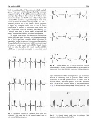 block is manifested by AV dissociation in which regularly
spaced P waves are not related temporally to the ventricular
escape rhythm (Fig. 4). The QRS duration may be normal or
prolonged depending on the location of the block; more
proximal blocks (ie, near the AV node) will typically result in
a normal QRS duration. Congenital complete heart block
occurs in infants of mothers carrying anti-Ro and anti-La
antibodies; mothers may or may not have clinical symptoms
of lupus [8]. Complete heart block is also a known
complication of surgery for congenital heart disease and
has a significant effect on morbidity and mortality [9].
Complete heart block is almost always symptomatic and
usually requires dual-chamber pacemaker implantation.
The bundle branches are the downstream limbs of the
bundle of His and allow for nearly synchronous depolariza-
tion of the left and right ventricles, which is important in
maintaining cardiac synchrony. Prolongation of conduction
through the bundle branches results in QRS prolongation and
is known as bundle branch block (BBB). Bundle branch
block can affect the right or left bundle branches (RBBB,
LBBB) and be classified as complete or incomplete, based
upon whether there is QRS prolongation for age. Incomplete
RBBB is commonly seen in pediatric ECGs and is
manifested by an rSR′ pattern in lead V1 and a small S
wave in lead V6; the initial upstroke of the QRS is normal
with a delay in the terminal portion of the QRS complex
(Fig. 5). Right bundle branch block is detected in V1; the
Fig. 5 Incomplete RBBB in a 3-week-old male infant after
tetralogy of Fallot repair. Note the rSR′ pattern in leads V1 and V2
with minimal QRS prolongation.
Fig. 6 Complete RBBB in a 19-year-old adolescent girl with
repaired tetralogy of Fallot. Note the similarity of the rSR′ pattern to
the previous figure, with this ECG manifesting QRS prolongation.
Fig. 7 Left bundle branch block. Note the prolonged QRS
duration in the lateral precordial lead V5.
351The pediatric ECG
 