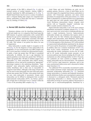 initial upstroke of the QRS is delayed (Fig. 6) with the
terminal portion of normal duration, whereas LBBB is
typically manifested by QRS prolongation in V6 (Fig. 7).
Bundle branch blocks may be seen in a variety of conditions
and is a frequent finding after surgery for congenital heart
disease, particularly in which there has been a ventriculot-
omy (ie, tetralogy of Fallot) [10].
4. Normal QRS duration tachycardias
Numerous schemes exist for classifying tachycardias; a
useful and simple way is to categorize them based upon the
QRS duration. In general, tachycardias with a normal QRS
duration for age can be considered as originating superior to
the AV node, whereas tachycardias associated with QRS
prolongation typically originate at locations inferior to the
AV node. This scheme is not perfect but allows for ease
of organization.
Sinus tachycardia is usually simple to recognize on the
ECG (Fig. 8). For the diagnosis of sinus tachycardia to be
established, a P wave must precede every QRS complex and
the P waves must have a normal axis (discussed previously).
In adults, a heart rate greater than 100 bpm is considered
tachycardia. In children, this rate is age dependent but
general guidelines exist; heart rates greater than 160 bpm in
infants and greater than 140 bpm in children suggest sinus
tachycardia [11]. Sinus tachycardia often reflects anxiety,
dehydration, or fever, and can be considered an “appropriate”
physiologic response to the underlying disturbance. “Inap-
propriate” sinus tachycardia implies underlying primary
cardiac disturbance and is often seen in myocarditis or
congestive heart failure. Although a wide range of heart rates
may be seen in sinus tachycardia, the sinus node rarely paces
at heart rates greater than 220 bpm; when greater heart rates
are seen, sinus tachycardia is uncommon. Ectopic atrial
tachycardias can be difficult to distinguish from so-called
supraventricular tachycardias (SVTs; see below), particu-
larly at high rates in which the P wave is “buried” within the
T wave of the preceding QRS complex (Fig. 9).
Atrial flutter and atrial fibrillation are quite rare in
pediatric patients. However, a form of atrial flutter can be
seen after surgery for congenital heart disease, particularly in
patients with Fontan-type operations and atrial switch
procedures for transposition of the great arteries [12]. Atrial
flutter is identified by so-called sawtooth waves representing
the rapid atrial rate with typically normal QRS duration.
Atrial fibrillation demonstrates chaotic irregular atrial
activity with an “irregularly irregular” ventricular rate;
QRS is usually normal in duration (Fig. 10).
Supraventricular tachycardia is one of the most common
arrhythmias encountered in pediatric patients (Fig. 11). The
term supraventricular tachycardia is confusing and does not
imply a single mechanism, however. Supraventricular
tachycardia includes any arrhythmia that requires atrial or
AV nodal tissue for their initiation and propagation, and
includes atrial tachycardias, atrial fibrillation, atrial flutter,
nodal tachycardia, junctional ectopic tachycardia, and others
[13] For the purposes of this discussion, SVT will be defined
as a paroxysmal tachyarrhythmia manifested by the absence
of P waves and by the presence of normal QRS complexes.
In children, there are 2 common mechanisms of SVT [14].
Both involve reentry mechanisms. In AV nodal reentry
tachycardia the reentry mechanism involves the AV node,
and in AV reentry tachycardia reentry proceeds via an
accessory pathway near, but not including, the AV node. Two
mechanisms are often indistinguishable via ECG. Preexcita-
tion syndromes are more common in children with AV
reentry tachycardia and are discussed below. The treatment
of SVT involves vagal maneuvers, adenosine, and in rare
cases synchronized cardioversion and is discussed in further
detail elsewhere [15].
Two additional SVTs occasionally encountered in pedia-
trics include junctional ectopic tachycardia and permanent
junctional reciprocating tachycardia (Fig. 12). Junctional
ectopic tachycardia is a common and frequently hemodyna-
mically deleterious rhythm seen in postoperative patients and
is discussed in a subsequent article. Permanent junctional
reciprocating tachycardia is a chronic, incessant form of
tachycardia involving an accessory pathway that presents in
infants and is electrocardiographically manifested by a
Fig. 8 Sinus tachycardia detected on Holter monitoring of a 6-year-old girl with near syncope. The heart rate is regular at 157 bpm.
352 M. O’Connor et al.
 