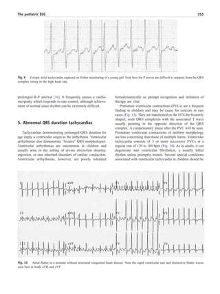 prolonged R-P interval [16]. It frequently causes a cardio-
myopathy which responds to rate control, although achieve-
ment of normal sinus rhythm can be extremely difficult.
5. Abnormal QRS duration tachycardias
Tachycardias demonstrating prolonged QRS duration for
age imply a ventricular origin to the arrhythmia. Ventricular
arrhythmias also demonstrate “bizarre” QRS morphologies.
Ventricular arrhythmias are uncommon in children and
usually arise in the setting of severe electrolyte disarray,
ingestion, or rare inherited disorders of cardiac conduction.
Ventricular arrhythmias, however, are poorly tolerated
hemodynamically so prompt recognition and initiation of
therapy are vital.
Premature ventricular contractions (PVCs) are a frequent
finding in children and may be cause for concern in rare
cases (Fig. 13). They are manifested on the ECG by bizarrely
shaped, wide QRS complexes with the associated T wave
usually pointing in the opposite direction of the QRS
complex. A compensatory pause after the PVC will be seen.
Premature ventricular contractions of uniform morphology
are less concerning than those of multiple forms. Ventricular
tachycardia consists of 3 or more successive PVCs at a
regular rate of 120 to 180 bpm (Fig. 14). As in adults, it can
degenerate into ventricular fibrillation, a usually lethal
rhythm unless promptly treated. Several special conditions
associated with ventricular tachycardia in children should be
Fig. 10 Atrial flutter in a neonate without structural congenital heart disease. Note the rapid ventricular rate and distinctive flutter waves
seen best in leads aVR and aVF.
Fig. 9 Ectopic atrial tachycardia captured on Holter monitoring of a young girl. Note how the P waves are difficult to separate from the QRS
complex owing to the high heart rate.
353The pediatric ECG
 