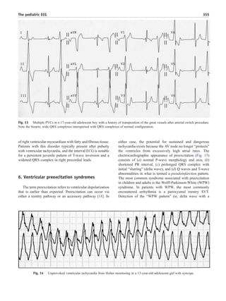 of right ventricular myocardium with fatty and fibrous tissue.
Patients with this disorder typically present after puberty
with ventricular tachycardia, and the interval ECG is notable
for a persistent juvenile pattern of T-wave inversion and a
widened QRS complex in right precordial leads.
6. Ventricular preexcitation syndromes
The term preexcitation refers to ventricular depolarization
that is earlier than expected. Preexcitation can occur via
either a reentry pathway or an accessory pathway [18]. In
either case, the potential for sustained and dangerous
tachycardia exists because the AV node no longer “protects”
the ventricles from excessively high atrial rates. The
electrocardiographic appearance of preexcitation (Fig. 15)
consists of (a) normal P-wave morphology and axis, (b)
shortened PR interval, (c) prolonged QRS complex with
initial “slurring” (delta wave), and (d) Q waves and T-wave
abnormalities in what is termed a pseudoinfarction pattern.
The most common syndrome associated with preexcitation
in children and adults is the Wolff-Parkinson-White (WPW)
syndrome. In patients with WPW, the most commonly
encountered arrhythmia is a paroxysmal reentry SVT.
Detection of the “WPW pattern” (ie, delta wave with a
Fig. 14 Unprovoked ventricular tachycardia from Holter monitoring in a 13-year-old adolescent girl with syncope.
Fig. 13 Multiple PVCs in a 17-year-old adolescent boy with a history of transposition of the great vessels after arterial switch procedure.
Note the bizarre, wide QRS complexes interspersed with QRS complexes of normal configuration.
355The pediatric ECG
 