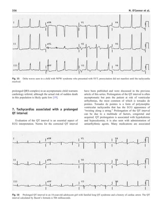 prolonged QRS complex) in an asymptomatic child warrants
cardiology referral, although the actual risk of sudden death
in this population is likely quite low [19].
7. Tachycardias associated with a prolonged
QT interval
Evaluation of the QT interval is an essential aspect of
ECG interpretation. Norms for the corrected QT interval
have been published and were discussed in the previous
article of this series. Prolongation of the QT interval is often
asymptomatic but puts the patient at risk of ventricular
arrhythmias, the most common of which is torsades de
pointes. Torsades de pointes is a form of polymorphic
ventricular tachycardia that has the ECG appearance of
“twisting along a string.” Prolongation of the QT interval
can be due to a multitude of factors, congenital and
acquired. QT prolongation is associated with hypokalemia
and hypocalcemia; it is also seen with administration of
antiarrhythmic agents. Many medications are associated
Fig. 16 Prolonged QT interval in an 18-year-old adolescent girl with familial long QT syndrome and a history of cardiac arrest. The QT
interval calculated by Bazett's formula is 506 milliseconds.
Fig. 15 Delta waves seen in a child with WPW syndrome who presented with SVT; preexcitation did not manifest until the tachycardia
resolved.
356 M. O’Connor et al.
 