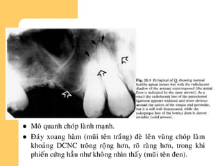  Moâ quanh choùp laønh maïnh.
 Ñaùy xoang haøm (muõi teân traéng) ñeø leân vuøng choùp laøm
khoaûng DCNC troâng roäng hôn, roõ raøng hôn, trong khi
phieán cöùng haàu nhö khoâng nhìn thaáy (muõi teân ñen).
 