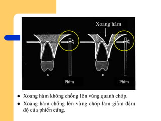 Xoang haøm
Phim Phim
 Xoang haøm khoâng choàng leân vuøng quanh choùp.
 Xoang haøm choàng leân vuøng choùp laøm giaûm ñaäm
ñoä cuûa phieán cöùng.
 