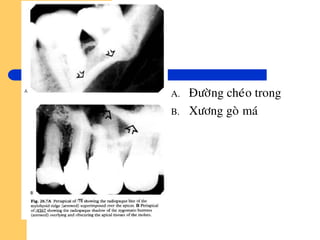 A. Ñöôøng cheùo trong
B. Xöông goø maù
 