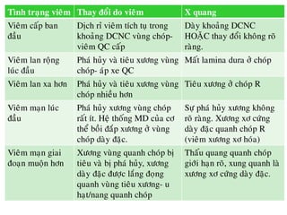 Tình traïng vieâm Thay ñoåi do vieâm X quang
Vieâm caáp ban
ñaàu
Dòch ræ vieâm tích tuï trong
khoaûng DCNC vuøng choùp-
vieâm QC caáp
Daøy khoaûng DCNC
HOAËC thay ñoåi khoâng roõ
raøng.
Vieâm lan roäng
luùc ñaàu
Phaù huûy vaø tieâu xöông vuøng
choùp- aùp xe QC
Maát lamina dura ôû choùp
Vieâm lan xa hôn Phaù huûy vaø tieâu xöông vuøng
choùp nhieàu hôn
Tieâu xöông ôû choùp R
Vieâm maïn luùc
ñaàu
Phaù huûy xöông vuøng choùp
raát ít. Heä thoáng MD cuûa cô
theå boài ñaép xöông ôû vuøng
choùp daøy ñaëc.
Söï phaù huûy xöông khoâng
roõ raøng. Xöông xô cöùng
daøy ñaëc quanh choùp R
(vieâm xöông xô hoùa)
Vieâm maïn giai
ñoaïn muoän hôn
Xöông vuøng quanh choùp bò
tieâu vaø bò phaù huûy, xöông
daøy ñaëc ñöôïc laéng ñoïng
quanh vuøng tieâu xöông- u
haït/nang quanh choùp
Thaáu quang quanh choùp
giôùi haïn roõ, xung quanh laø
xöông xô cöùng daøy ñaëc.
 
