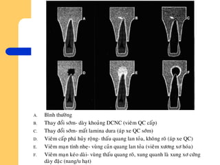A. Bình thöôøng
B. Thay ñoåi sôùm- daøy khoaûng DCNC (vieâm QC caáp)
C. Thay ñoåi sôùm- maát lamina dura (aùp xe QC sôùm)
D. Vieâm caáp phaù huûy roäng- thaáu quang lan toûa, khoâng roõ (aùp xe QC)
E. Vieâm maïn tính nheï- vuøng caûn quang lan toûa (vieâm xöông xô hoùa)
F. Vieâm maïn keùo daøi- vuøng thaáu quang roõ, xung quanh laø xung xô cöùng
daøy ñaëc (nang/u haït)
 