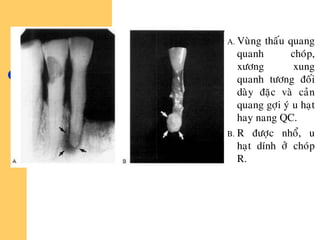 A. Vuøng thaáu quang
quanh choùp,
xöông xung
quanh töông ñoái
daøy ñaëc vaø caûn
quang gôïi yù u haït
hay nang QC.
B. R ñöôïc nhoå, u
haït dính ôû choùp
R.
 