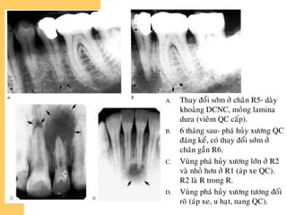 A. Thay ñoåi sôùm ôû chaân R5- daøy
khoaûng DCNC, moûng lamina
dura (vieâm QC caáp).
B. 6 thaùng sau- phaù huûy xöông QC
ñaùng keå, coù thay ñoåi sôùm ôû
chaân gaàn R6.
C. Vuøng phaù huûy xöông lôùn ôû R2
vaø nhoû hôn ôû R1 (aùp xe QC).
R2 laø R trong R.
D. Vuøng phaù huûy xöông töông ñoái
roõ (aùp xe, u haït, nang QC).
 