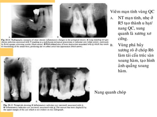 Nang quanh choùp
Vieâm maïn tính vuøng QC
A. NT maïn tính, nheï ôû
R5 taïo thaønh u haït/
nang QC, xung
quanh laø xöông xô
cöùng.
B. Vuøng phaù huûy
xöông roõ ôû choùp R6
laøm taùi caáu truùc saøn
xoang haøm, taïo hình
aûnh quaàng xoang
haøm.
 