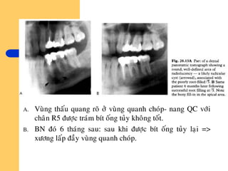 A. Vuøng thaáu quang roõ ôû vuøng quanh choùp- nang QC vôùi
chaân R5 ñöôïc traùm bít oáng tuûy khoâng toát.
B. BN ñoù 6 thaùng sau: sau khi ñöôïc bít oáng tuûy laïi =>
xöông laáp ñaày vuøng quanh choùp.
 