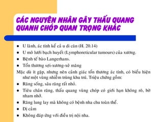 Caùc nguyeân nhaân gaây thaáu quang
quanh choùp quan troïng khaùc
 U laønh, aùc tính keå caû u di caên (H. 20.14)
 U moâ löôùi baïch huyeát (Lymphoreticular tumours) cuûa xöông.
 Beänh teá baøo Langerhans.
 Toån thöông sôïi-xöông-xeâ maêng
Maëc duø ít gaëp, nhöng neân caûnh giaùc toån thöông aùc tính, coù bieåu hieän
nhö moät vuøng nhieãm truøng khu truù. Trieäu chöùng goàm:
 Raêng soáng, saâu raêng raát nhoû.
 Tieâu chaân raêng, thaáu quang vuøng choùp coù giôùi haïn khoâng roõ, bôø
nham nhôû.
 Raêng lung lay maø khoâng coù beänh nha chu toaøn theå.
 Dò caûm
 Khoâng ñaùp öùng vôùi ñieàu trò noäi nha.
 