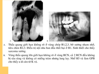 A. Thaáu quang giôùi haïn khoâng roõ ôû vuøng choùp R1,2,3, bôø xöông nham nhôû,
tieâu chaân R2,3. Ñieàu trò noäi nha ban ñaàu thaát baïi ôû R1. Sinh thieát cho thaáy
sarcoma xöông.
B. Vuøng thaáu quang lôùn giôùi haïn khoâng roõ ôû vuøng RCN, caû 2 RCN ñeàu khoâng
bò saâu raêng vaø khoâng coù mieáng traùm nhöng lung lay. Nhoå R5 vaø laøm GPB
cho thaáy u di caên töø K vuù.
 