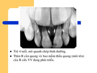  Treû 4 tuoåi, moâ quanh choùp bình thöôøng.
 Thaân R caûn quang vaø bao maàm thaáu quang (muõi teân)
cuûa R cöûa VV ñang phaùt trieån.
 