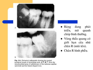  Raêng ñang phaùt
trieån, moâ quanh
choùp bình thöôøng.
 Vuøng thaáu quang coù
giôùi haïn cuûa nhuù
chaân R (muõi teân).
 Chaân R hình pheãu.
 