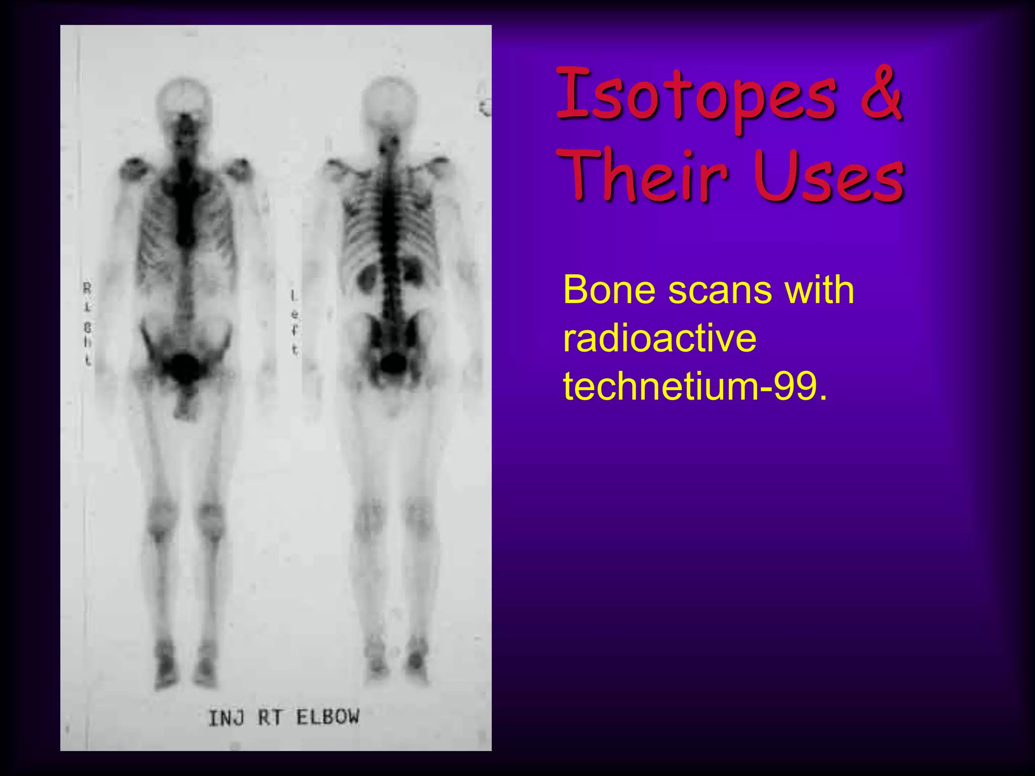 Isotopes &
Their Uses
Bone scans with
radioactive
technetium-99.
 