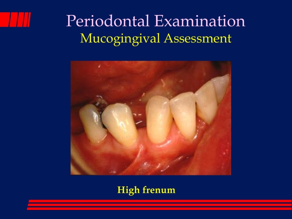 The periodontal examination_and_diagnosis_lec 1