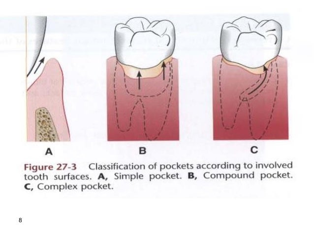 The periodontal pocket - lec 2