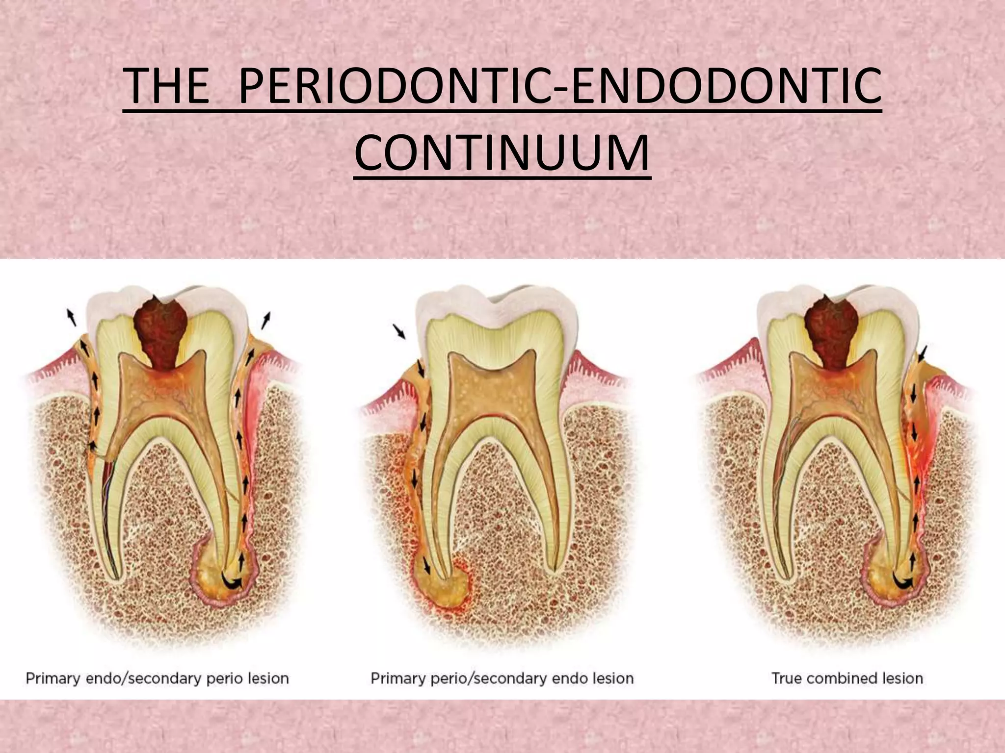 The PeriodonticEndodontic Continuum Understanding the Relationship