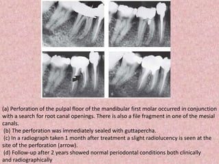 (a) Perforation of the pulpal floor of the mandibular first molar occurred in conjunction
with a search for root canal openings. There is also a file fragment in one of the mesial
canals.
(b) The perforation was immediately sealed with guttapercha.
(c) In a radiograph taken 1 month after treatment a slight radiolucency is seen at the
site of the perforation (arrow).
(d) Follow-up after 2 years showed normal periodontal conditions both clinically
and radiographically
 