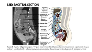 The Peritoneum radioanatomy overview.pptx