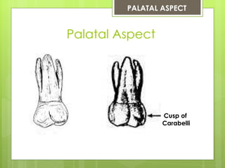 PALATAL ASPECT


Palatal Aspect




                 Cusp of
                 Carabelli
 