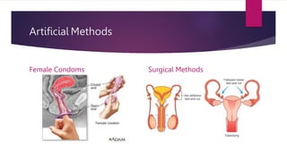 Artificial Methods
Female Condoms Surgical Methods
 