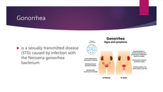Gonorrhea
 is a sexually transmitted disease
(STD) caused by infection with
the Neisseria gonorrhea
bacterium.
 