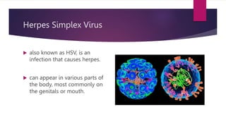 Herpes Simplex Virus
 also known as HSV, is an
infection that causes herpes.
 can appear in various parts of
the body, most commonly on
the genitals or mouth.
 