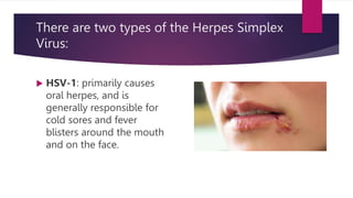 There are two types of the Herpes Simplex
Virus:
 HSV-1: primarily causes
oral herpes, and is
generally responsible for
cold sores and fever
blisters around the mouth
and on the face.
 