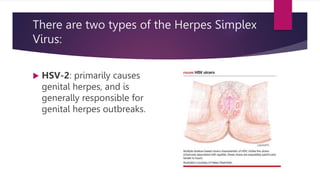 There are two types of the Herpes Simplex
Virus:
 HSV-2: primarily causes
genital herpes, and is
generally responsible for
genital herpes outbreaks.
 