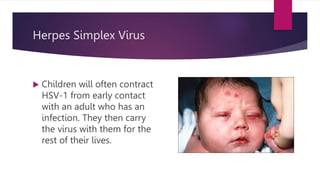 Herpes Simplex Virus
 Children will often contract
HSV-1 from early contact
with an adult who has an
infection. They then carry
the virus with them for the
rest of their lives.
 