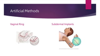 Artificial Methods
Vaginal Ring Subdermal Implants
 