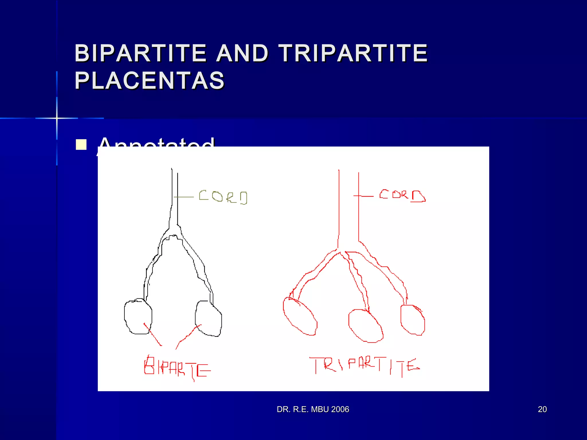 DR. R.E. MBU 2006DR. R.E. MBU 2006 2020
BIPARTITE AND TRIPARTITEBIPARTITE AND TRIPARTITE
PLACENTASPLACENTAS
 AnnotatedAnnotated
 