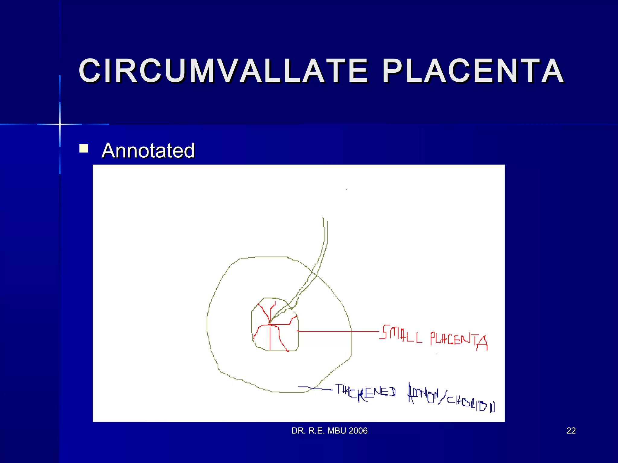 DR. R.E. MBU 2006DR. R.E. MBU 2006 2222
CIRCUMVALLATE PLACENTACIRCUMVALLATE PLACENTA
 AnnotatedAnnotated
 