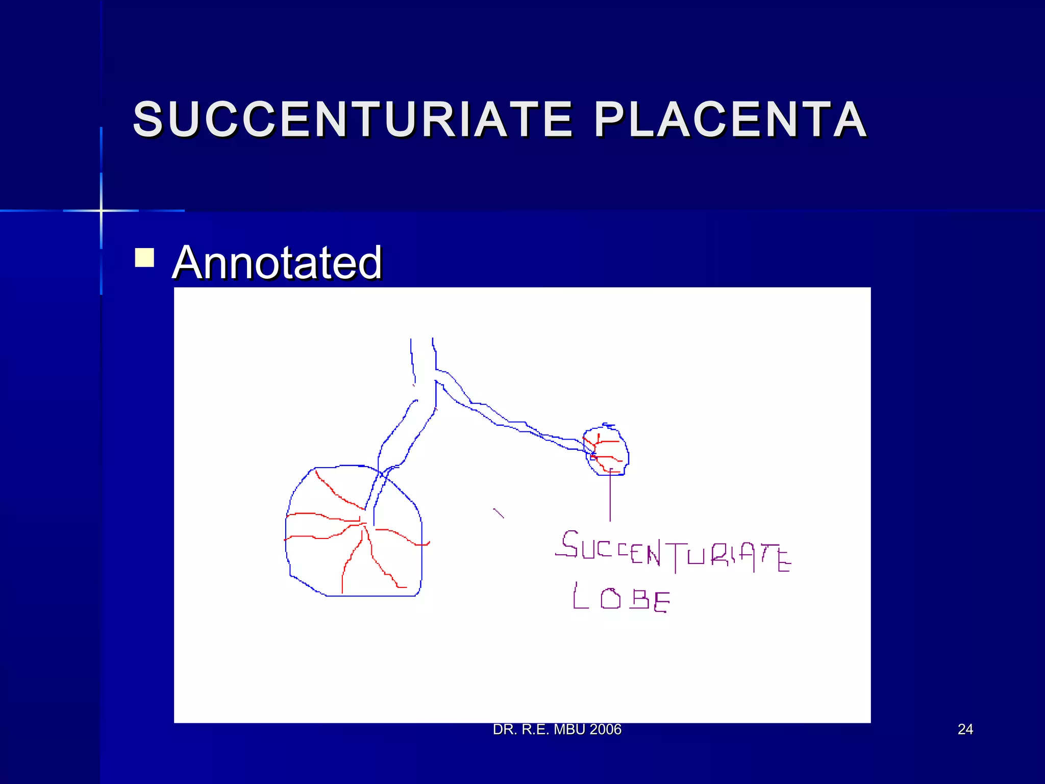 DR. R.E. MBU 2006DR. R.E. MBU 2006 2424
SUCCENTURIATE PLACENTASUCCENTURIATE PLACENTA
 AnnotatedAnnotated
 