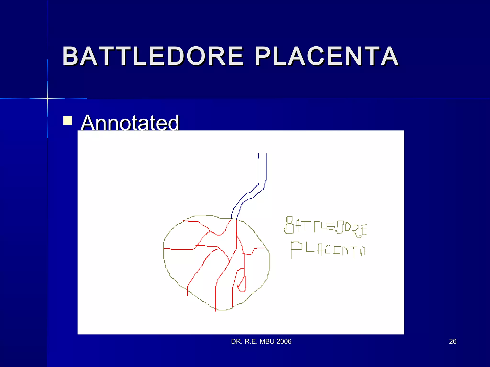 DR. R.E. MBU 2006DR. R.E. MBU 2006 2626
BATTLEDORE PLACENTABATTLEDORE PLACENTA
 AnnotatedAnnotated
 