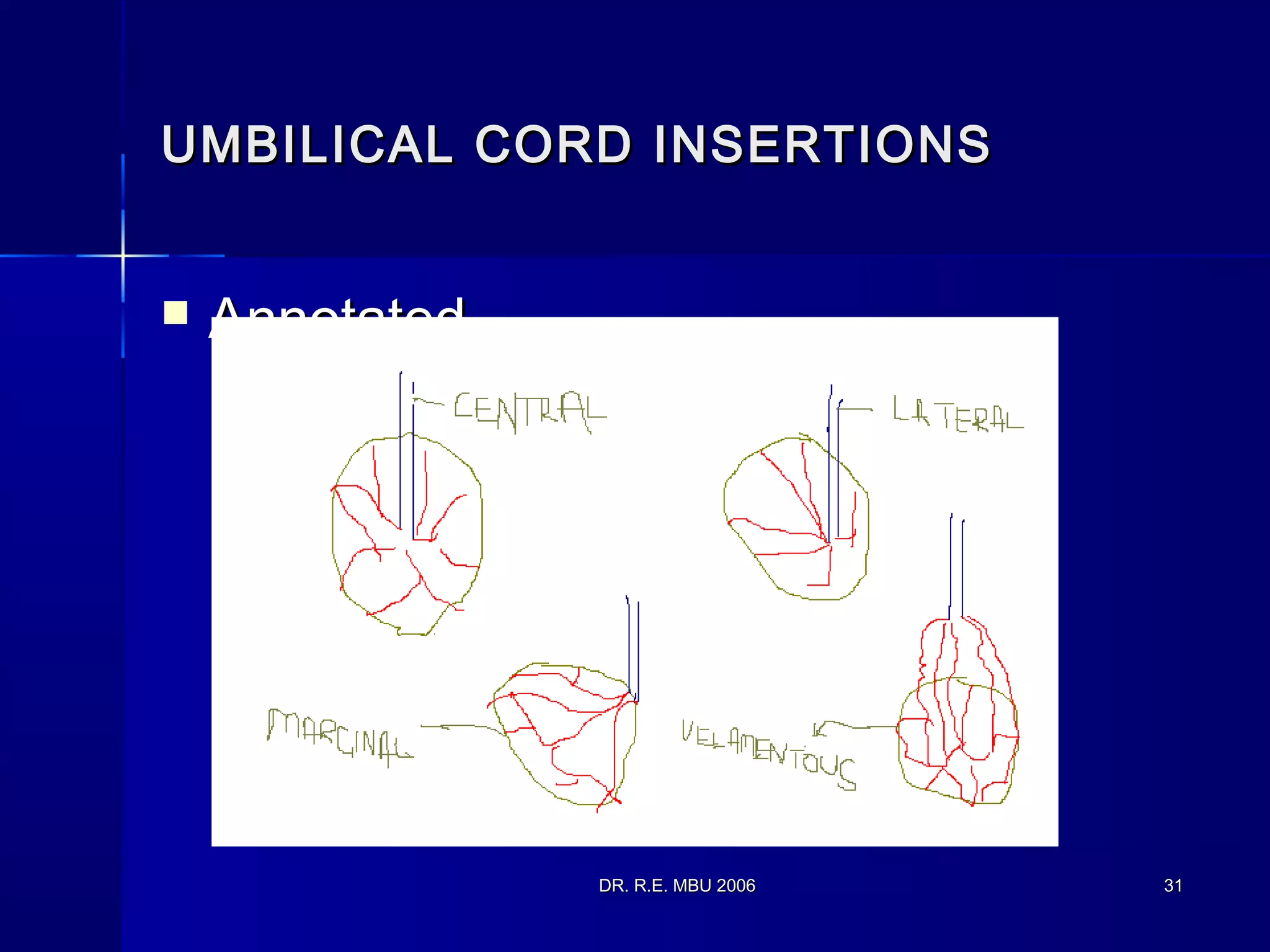 DR. R.E. MBU 2006DR. R.E. MBU 2006 3131
UMBILICAL CORD INSERTIONSUMBILICAL CORD INSERTIONS
 AnnotatedAnnotated
 