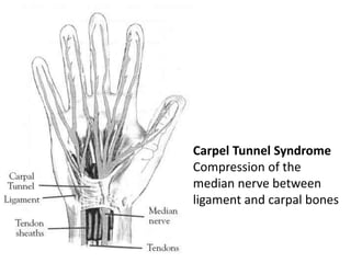 Carpel Tunnel Syndrome
Compression of the
median nerve between
ligament and carpal bones
 