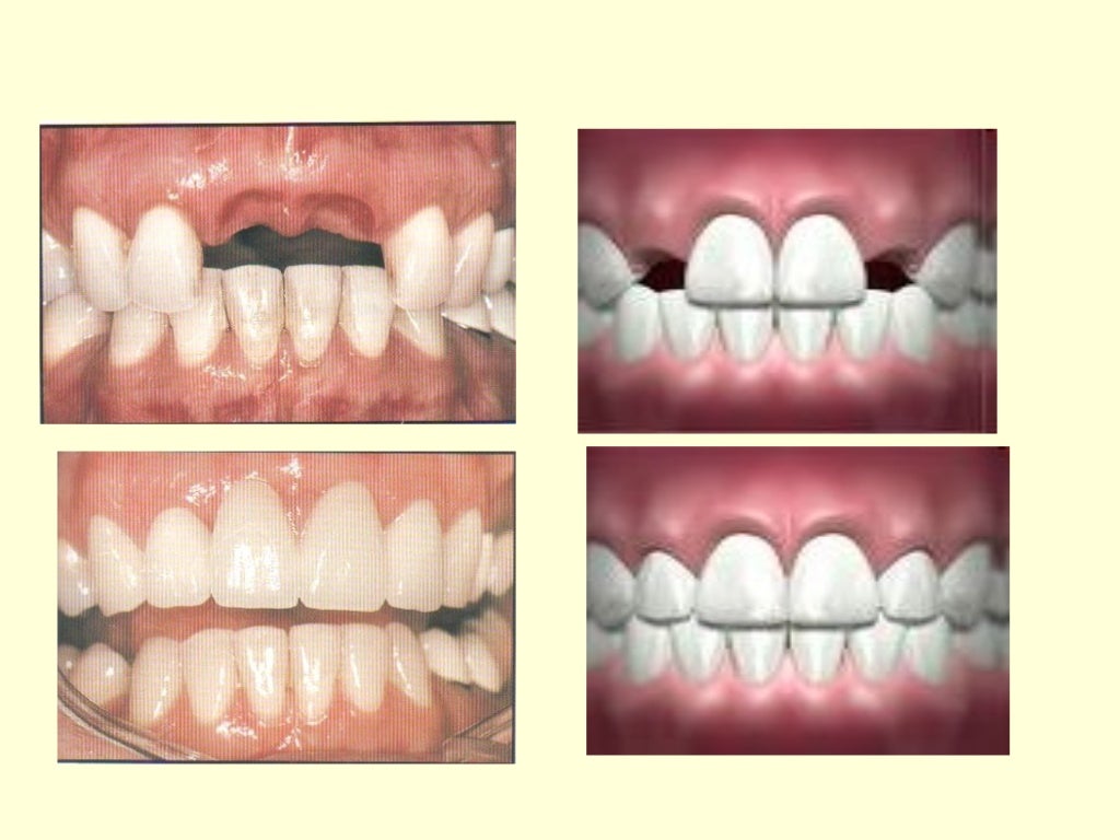 The pontics in_fixed_restorations