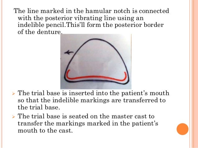posterior palatal seal