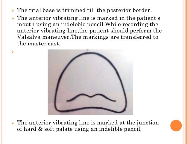 posterior palatal seal