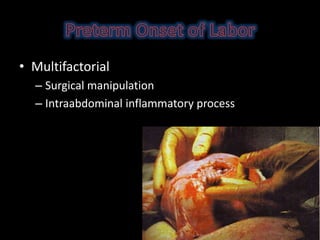 • Multifactorial
– Surgical manipulation
– Intraabdominal inflammatory process
 