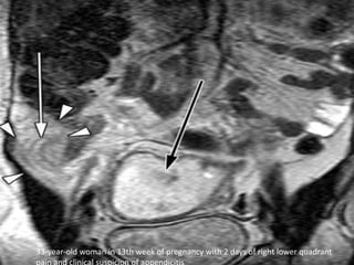 33-year-old woman in 13th week of pregnancy with 2 days of right lower quadrant
 