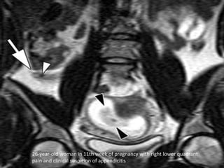 26-year-old woman in 11th week of pregnancy with right lower quadrant
pain and clinical suspicion of appendicitis
 
